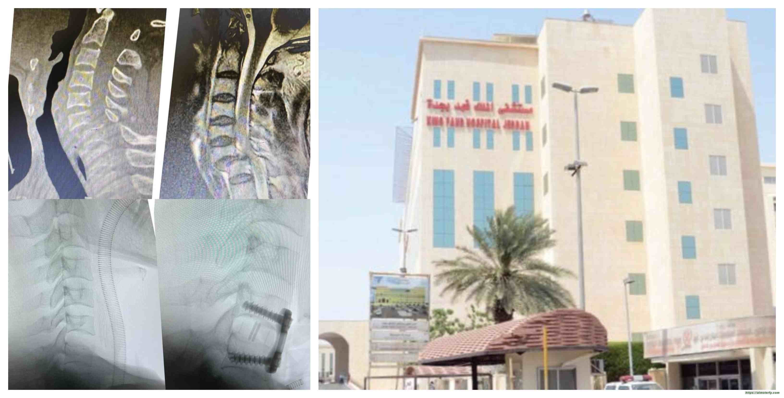 مستشفى الملك فهد ينجح في انقاذ مريض من الاصابة بشلل دائم محتم
